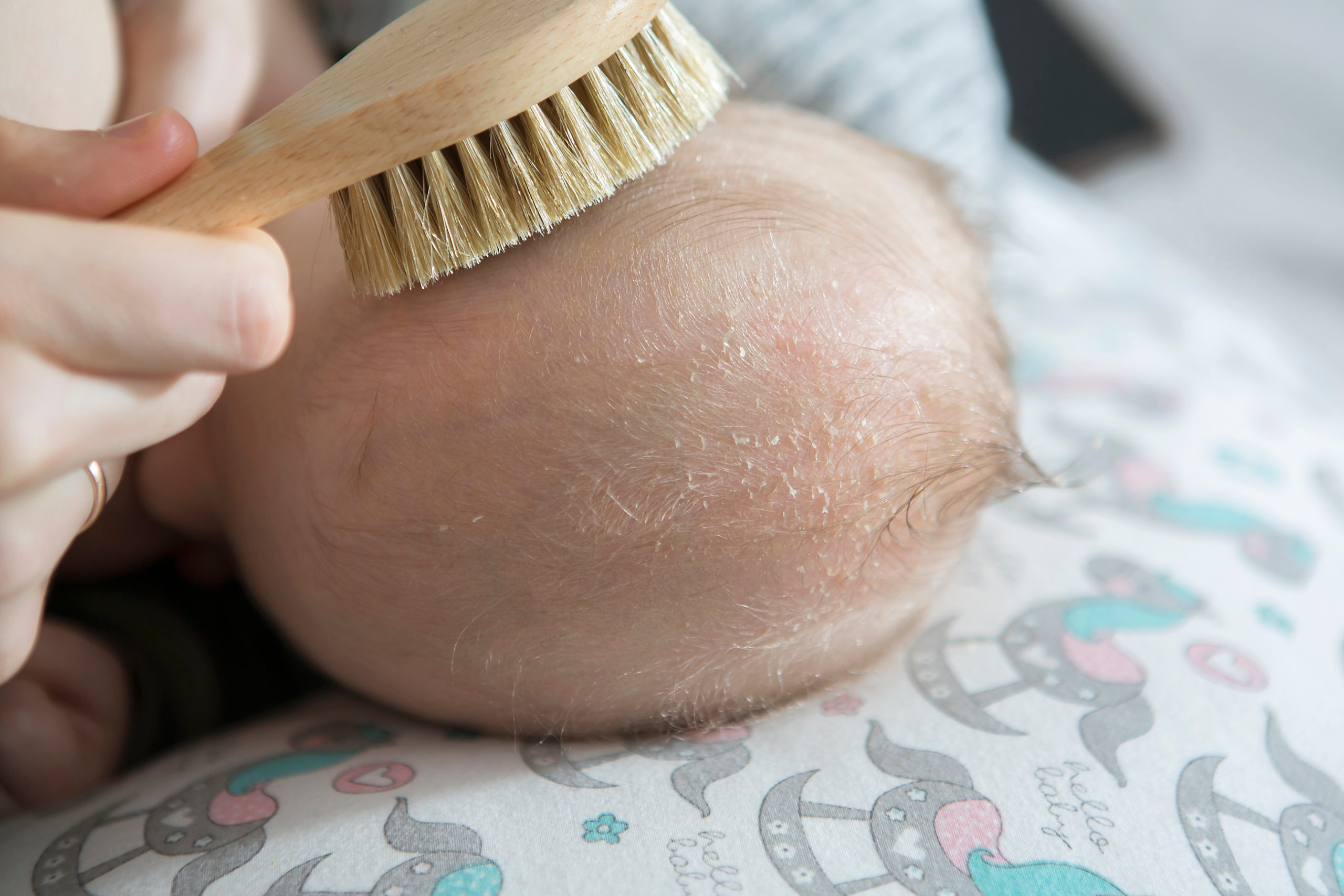 Cradle cap shops treatment coconut oil